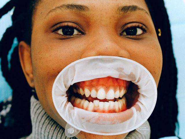 Hollywood Smile Dental Veneers